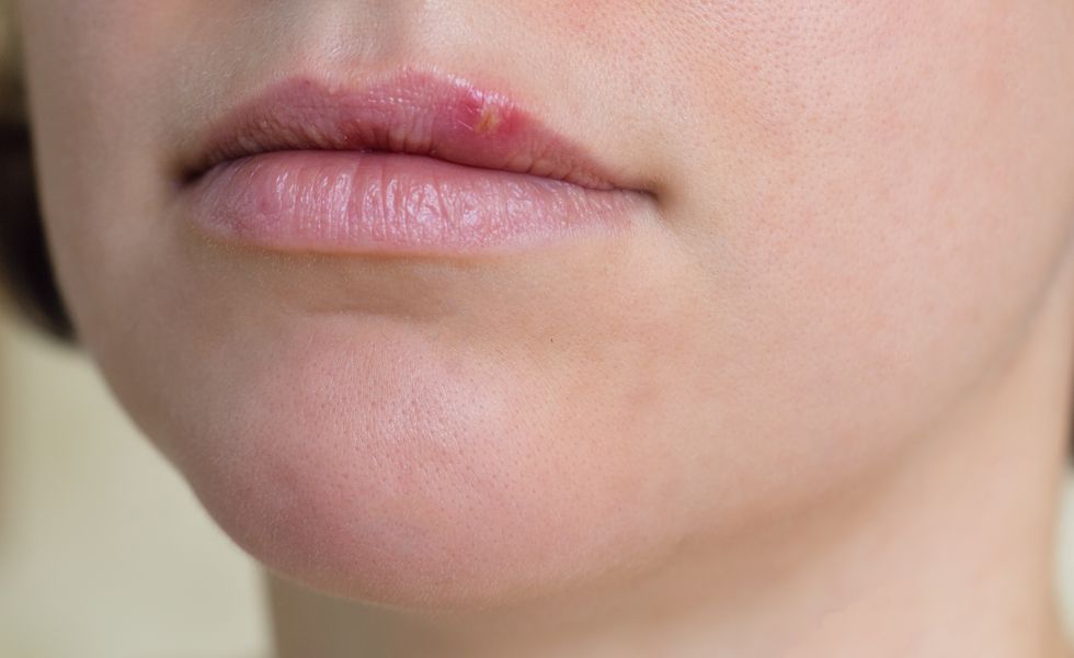 How to Get Rid of a Cold Sore?