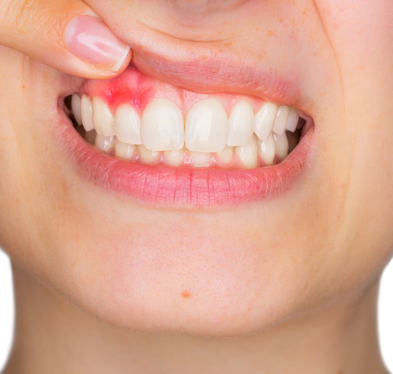 How To Cure Gum Disease Without A Dentist?