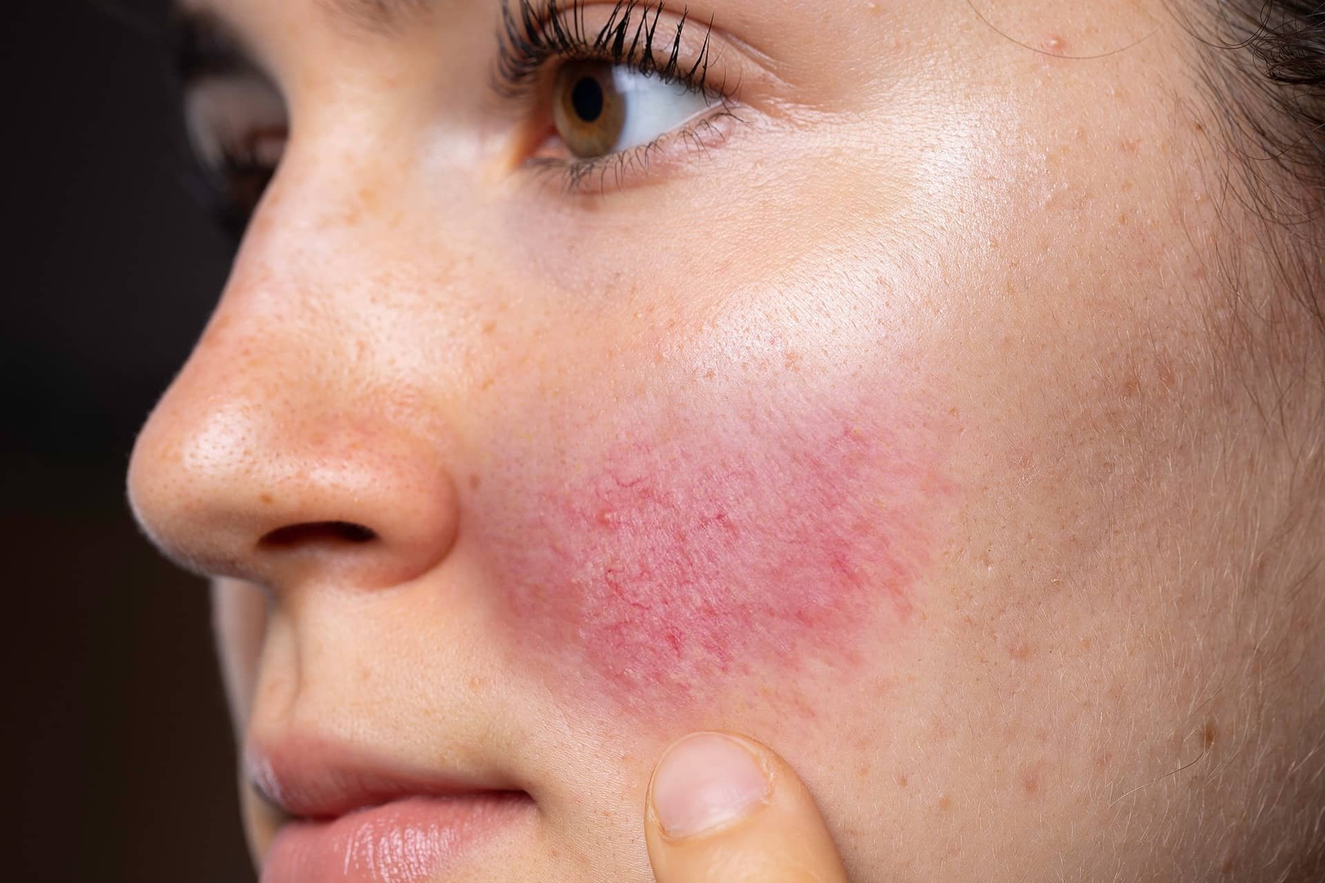 How To Get Rid Of Redness On Face?