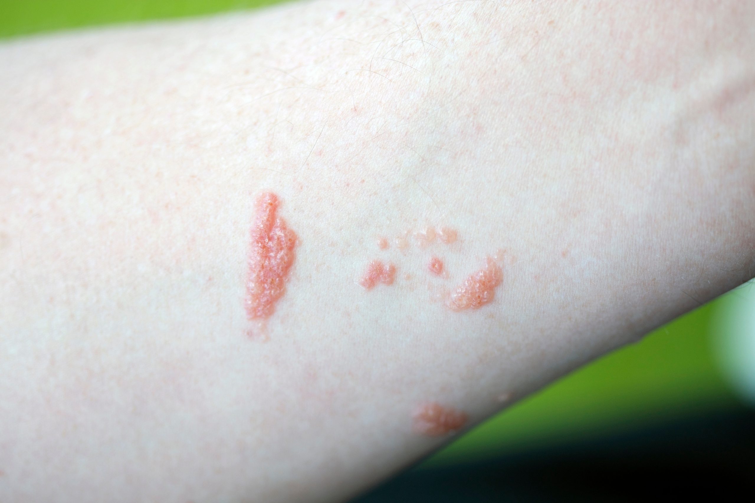 How to Get Rid of Poison Ivy Rash Overnight? Tips and Tricks